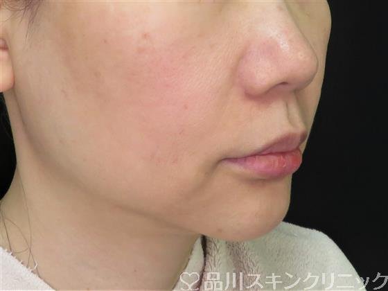 症例NO.59157のBEFORE写真