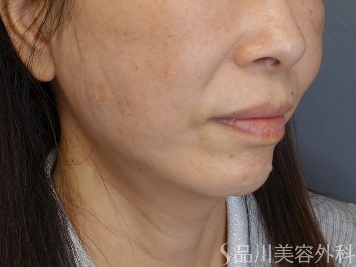 症例NO.72295のAFTER写真