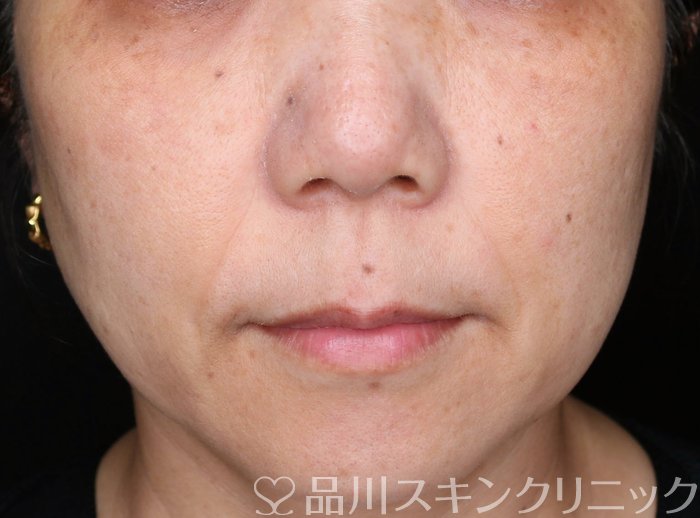 症例NO.66118のAFTER写真