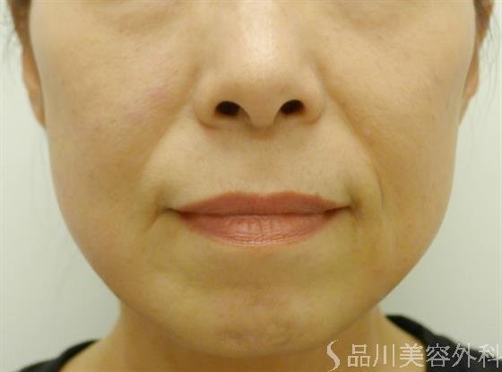症例NO.34141のBEFORE写真