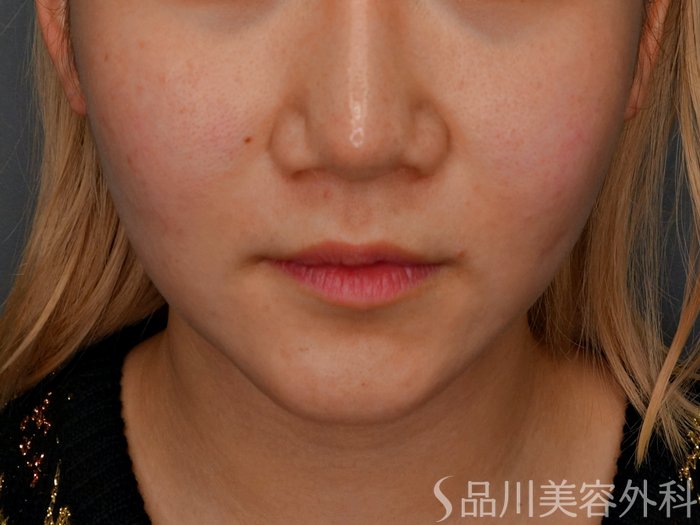 症例NO.73285のBEFORE写真