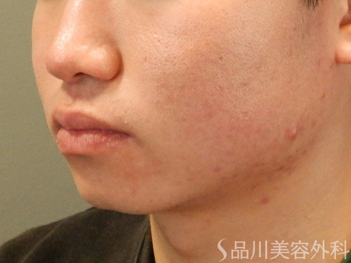 症例NO.70516のBEFORE写真