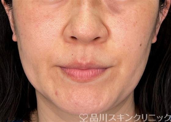 症例NO.59132のBEFORE写真