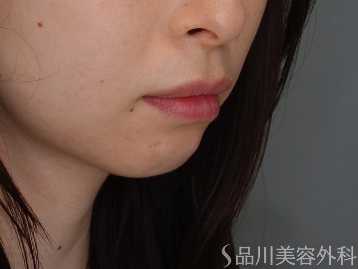 症例NO.69421のBEFORE写真