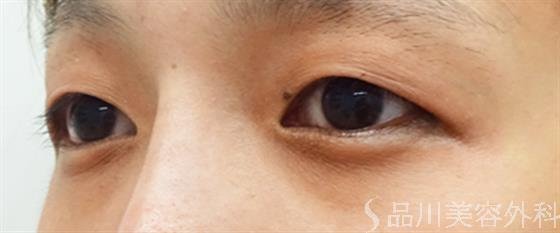 症例NO.45339のBEFORE写真