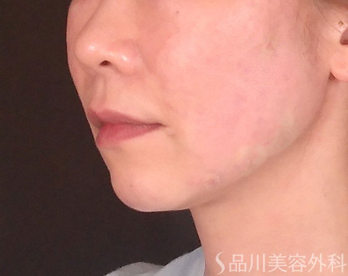 症例NO.70393のAFTER写真