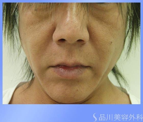 症例NO.2573のBEFORE写真