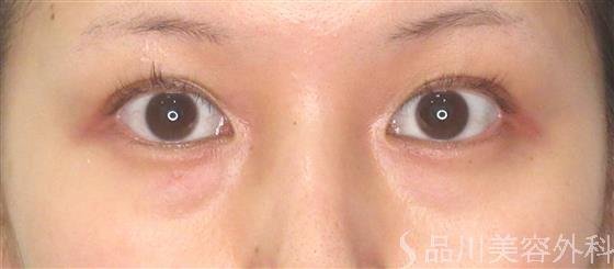 症例NO.52170のBEFORE写真