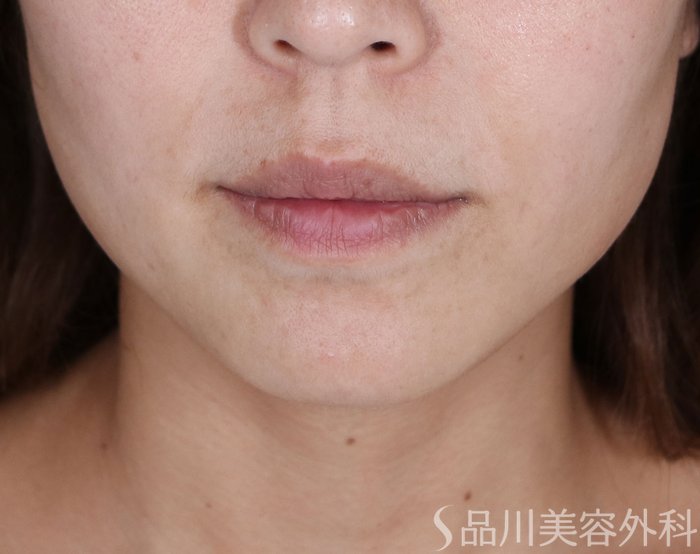 症例NO.74183のAFTER写真