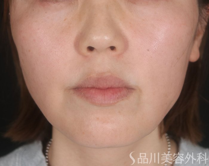 症例NO.73093のAFTER写真