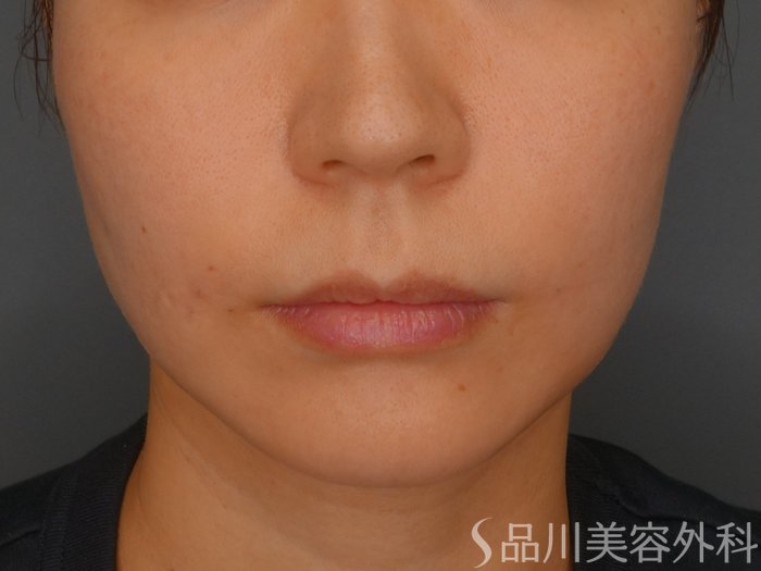 症例NO.73694のAFTER写真