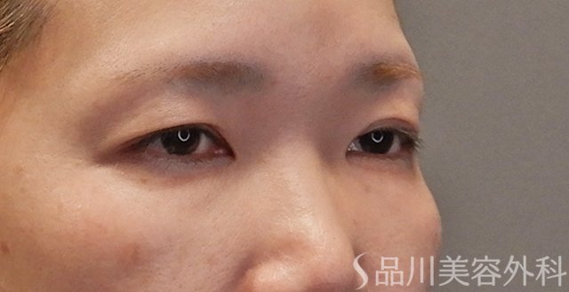 症例NO.74771のBEFORE写真