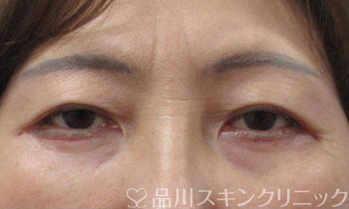 症例NO.69443のBEFORE写真