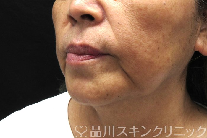 症例NO.75005のBEFORE写真