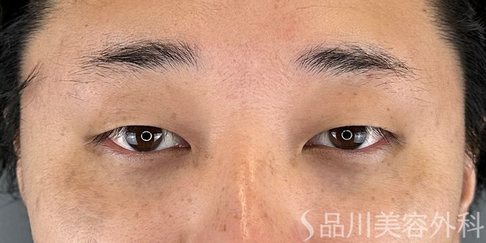 症例NO.72839のBEFORE写真