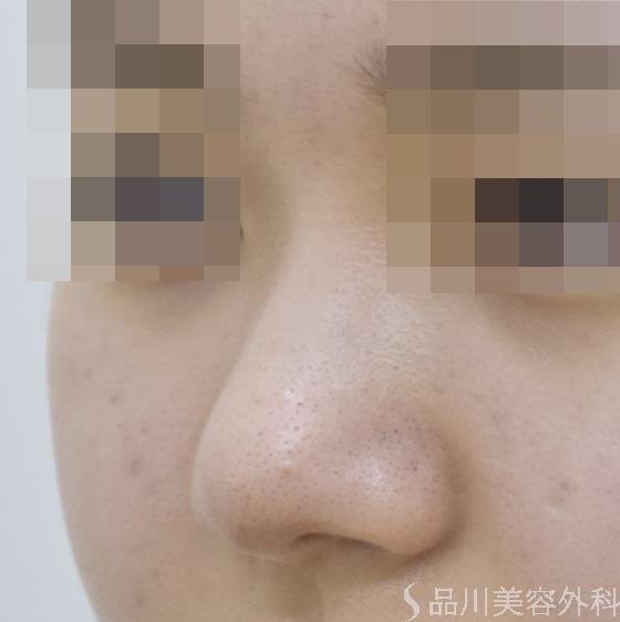 症例NO.47154のAFTER写真
