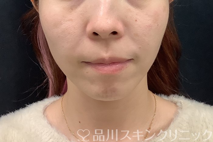 症例NO.69560のAFTER写真