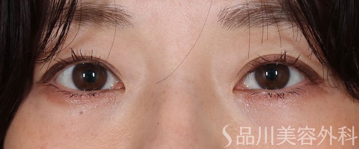 症例NO.72419のAFTER写真