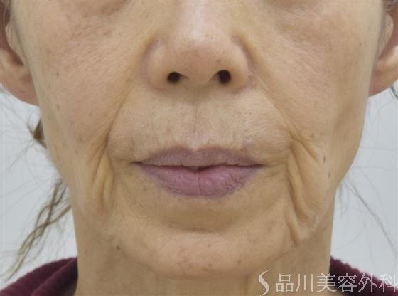 症例NO.44700のBEFORE写真