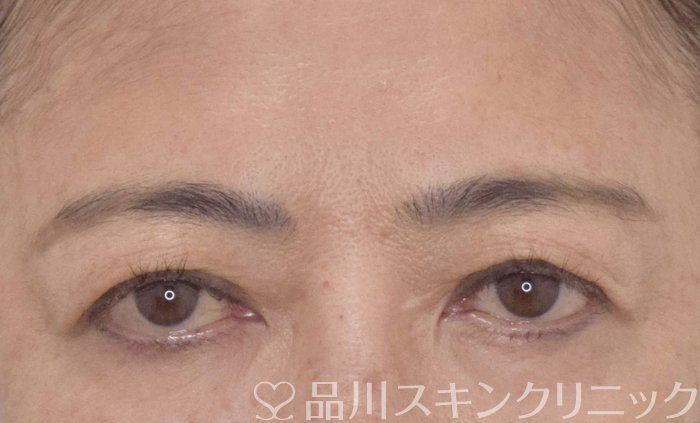 症例NO.62924のBEFORE写真