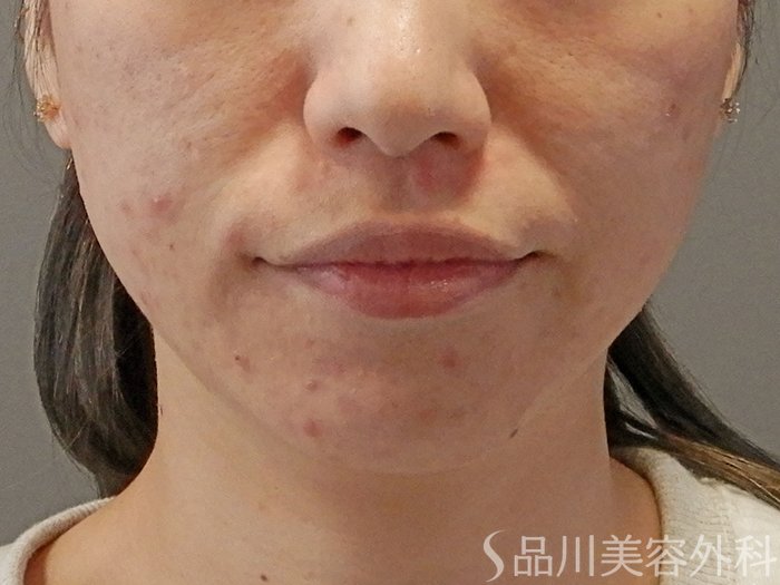 症例NO.71675のBEFORE写真