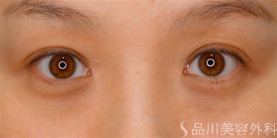 症例NO.54407のBEFORE写真