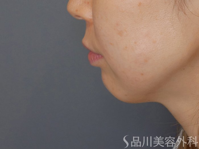 症例NO.70631のBEFORE写真