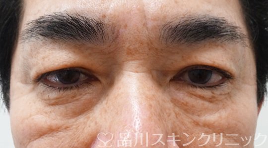 症例NO.69799のBEFORE写真