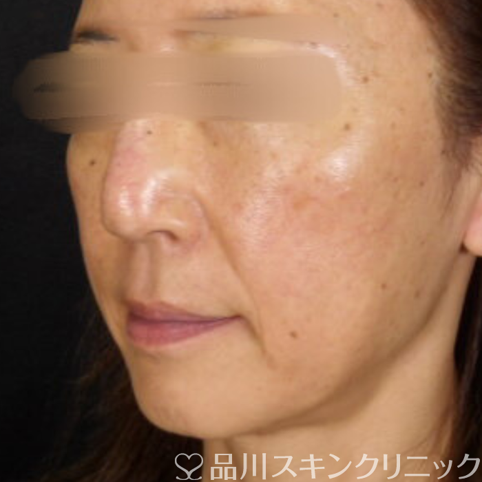 症例NO.71213のBEFORE写真