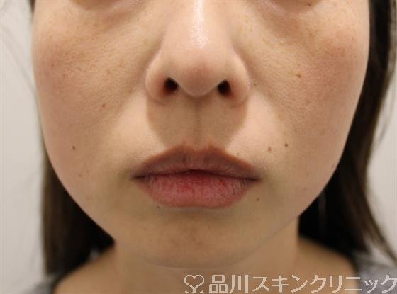症例NO.47961のBEFORE写真