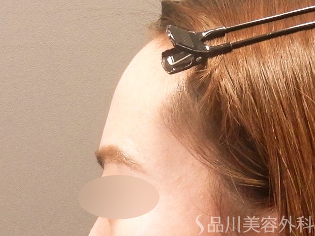 症例NO.69749のBEFORE写真