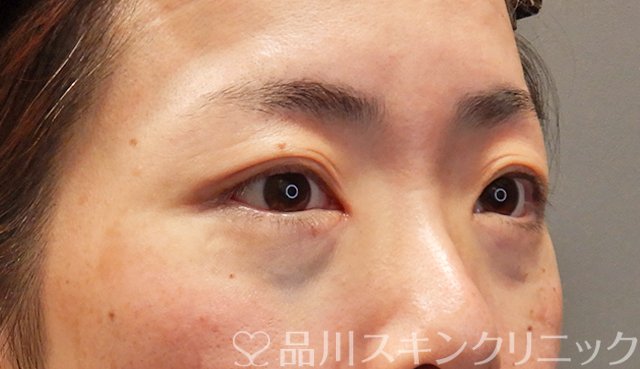 症例NO.68167のAFTER写真