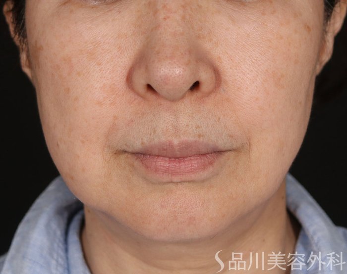 症例NO.74066のBEFORE写真