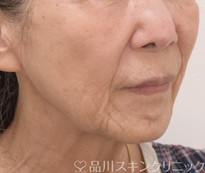 症例NO.73426のBEFORE写真