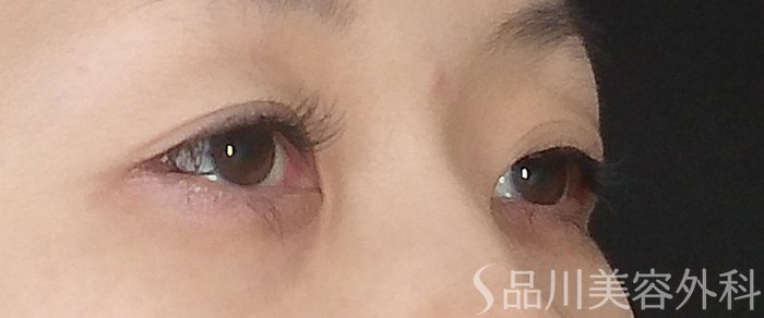 症例NO.65409のBEFORE写真