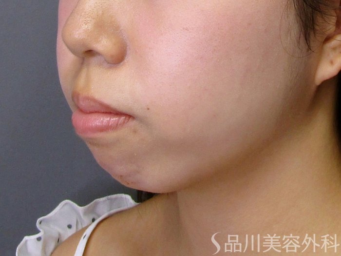 症例NO.75059のBEFORE写真