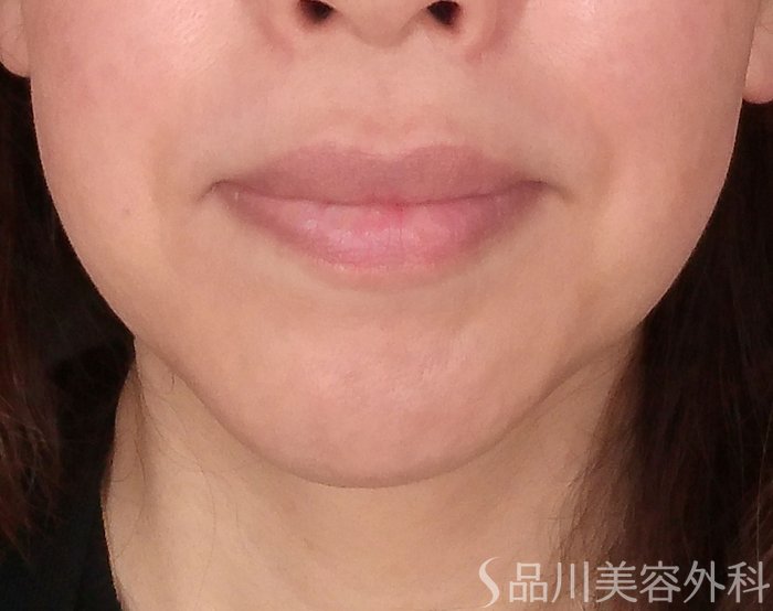 症例NO.69958のBEFORE写真