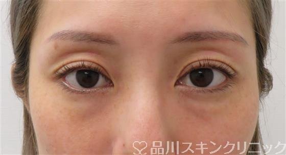 症例NO.58314のBEFORE写真