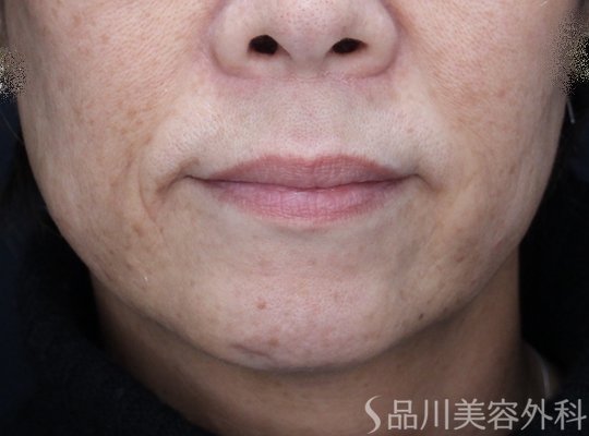 症例NO.72179のAFTER写真