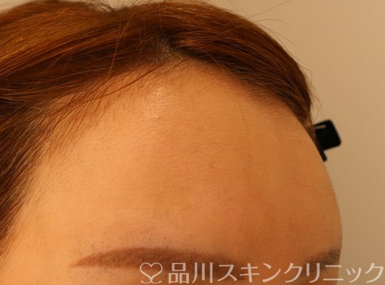 症例NO.74268のAFTER写真