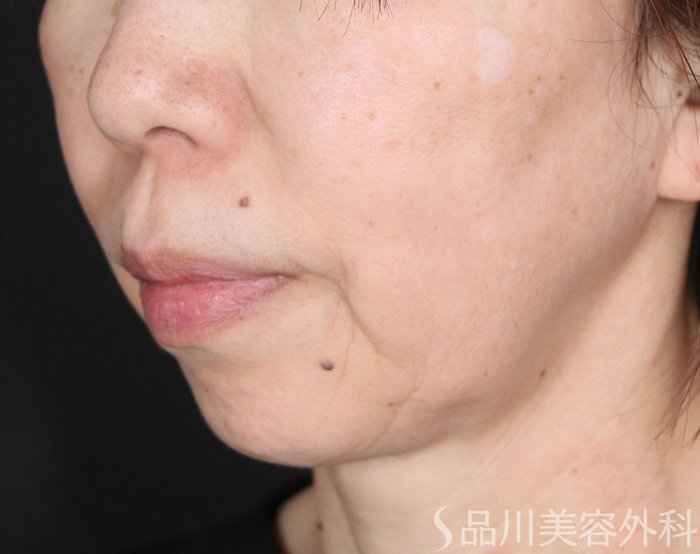 症例NO.73410のBEFORE写真