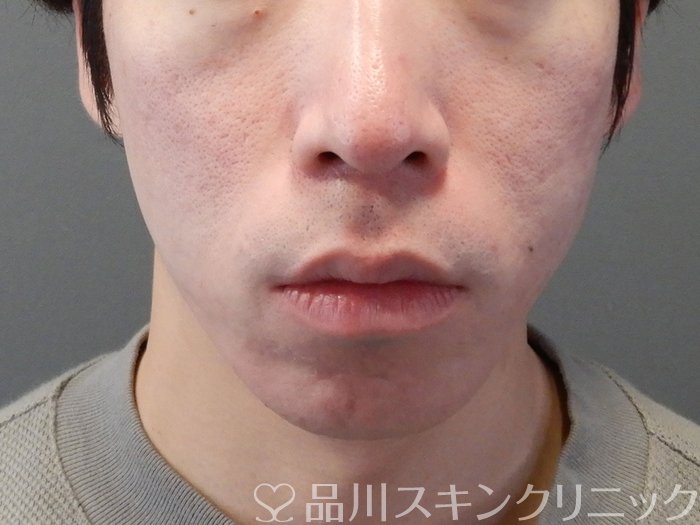 症例NO.70426のAFTER写真