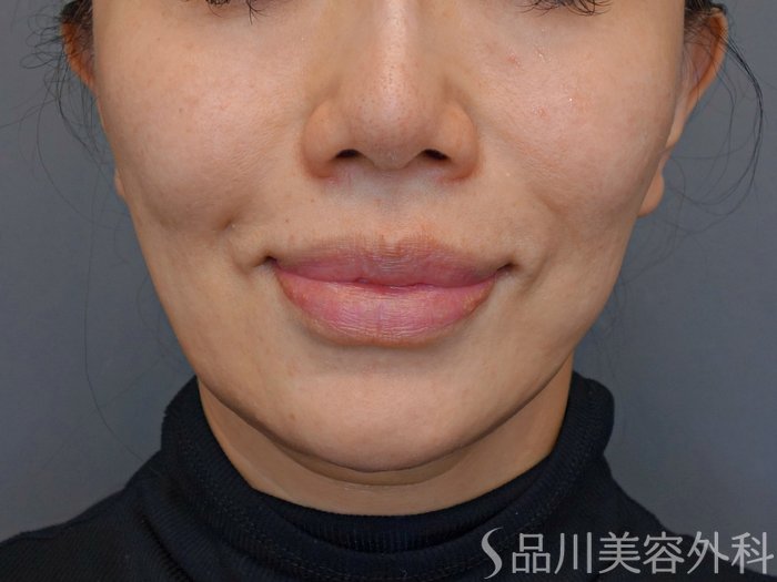症例NO.74194のBEFORE写真
