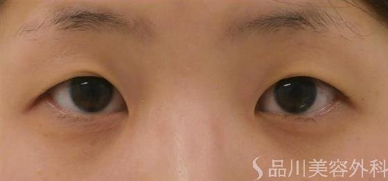症例NO.28959のBEFORE写真