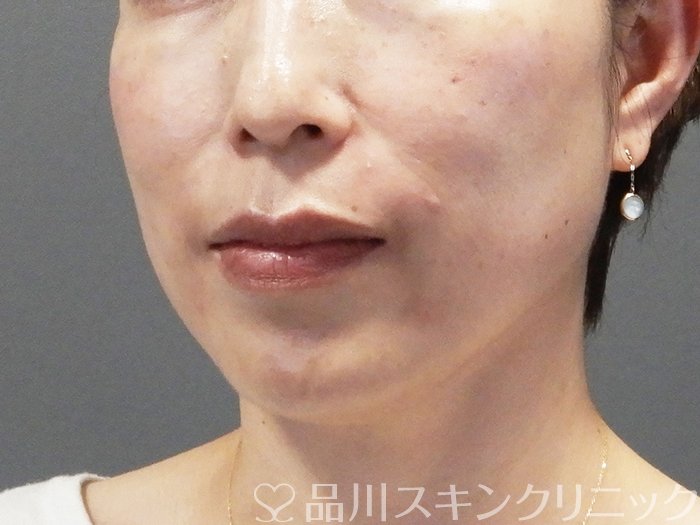 症例NO.74357のAFTER写真