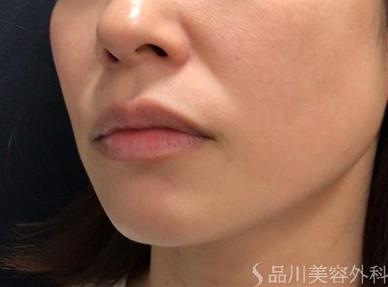 症例NO.59152のBEFORE写真