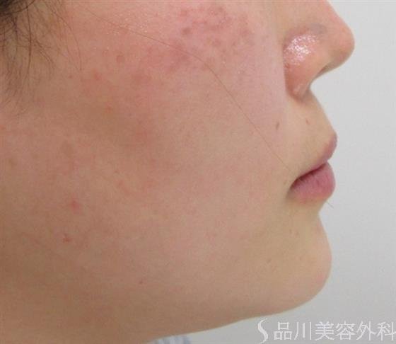 症例NO.43621のAFTER写真