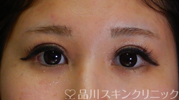 症例NO.63709のAFTER写真