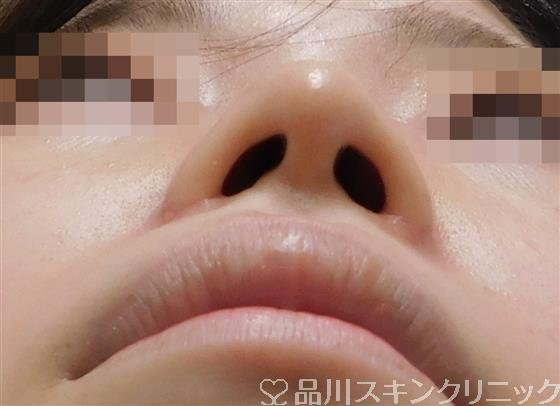 症例NO.56430のAFTER写真