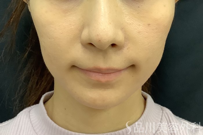 症例NO.69842のBEFORE写真